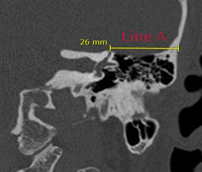 Manual neuronavigation for superior semicircular canal dehiscence surgery